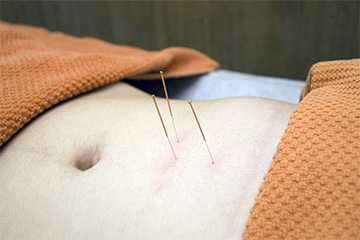 Acupuntura
